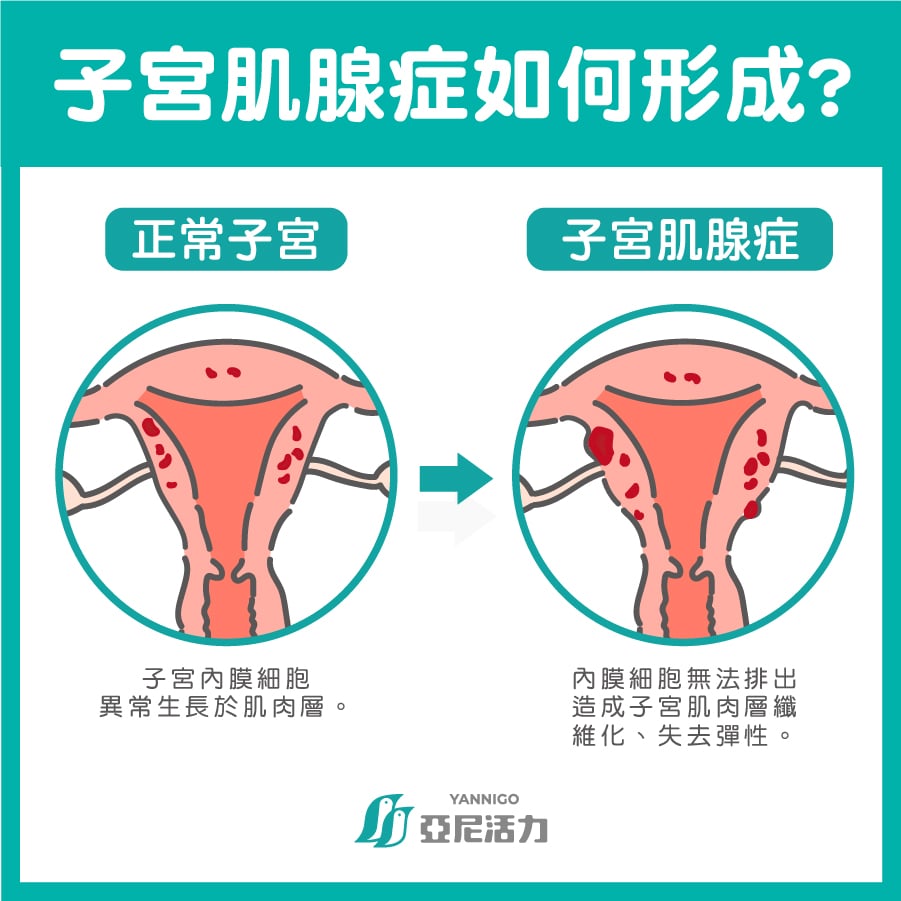 子宮肌腺症如何形成